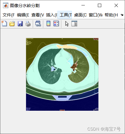 [chapter 06 MATLAB realizes lung cancer diagnosis based on watershed segmentation]