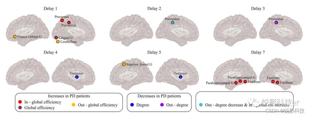 Cerebral Cortex:有向脑连接识别帕金森病中广泛存在的功能网络异常