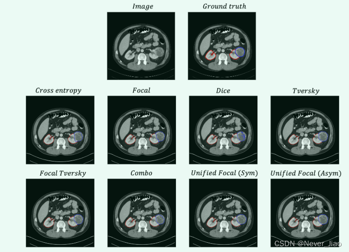 Unified Focal loss: Generalising Dice and cross entropy-based losses to handle class imbalanced medi