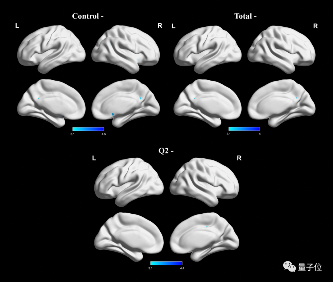 Internet addiction changes brain structure: language function is affected, making people unable to speak neatly